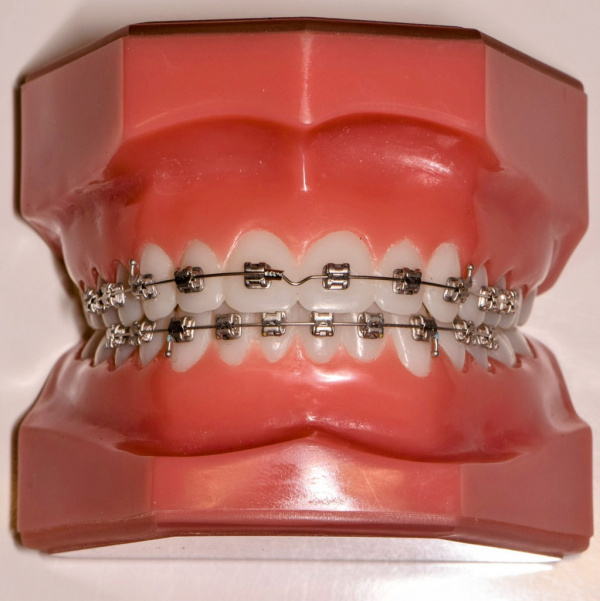 Festsitzende Zahnspange/Multiband - Atelier für Kieferorthopädie